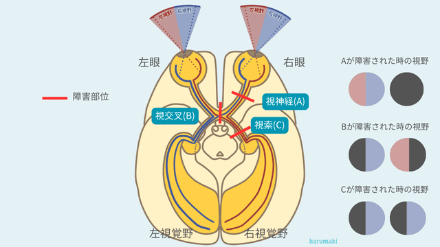 視覚伝導路と視野障害の参考図