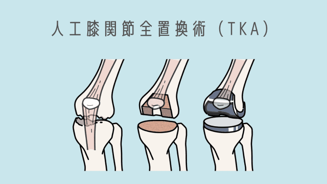 人工膝関節全置換術のイメージ図